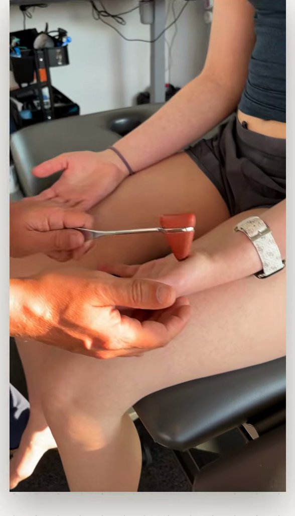 Close view of a reflex hammer tapping the muscle at the base of the thumb to test percussion myotonia